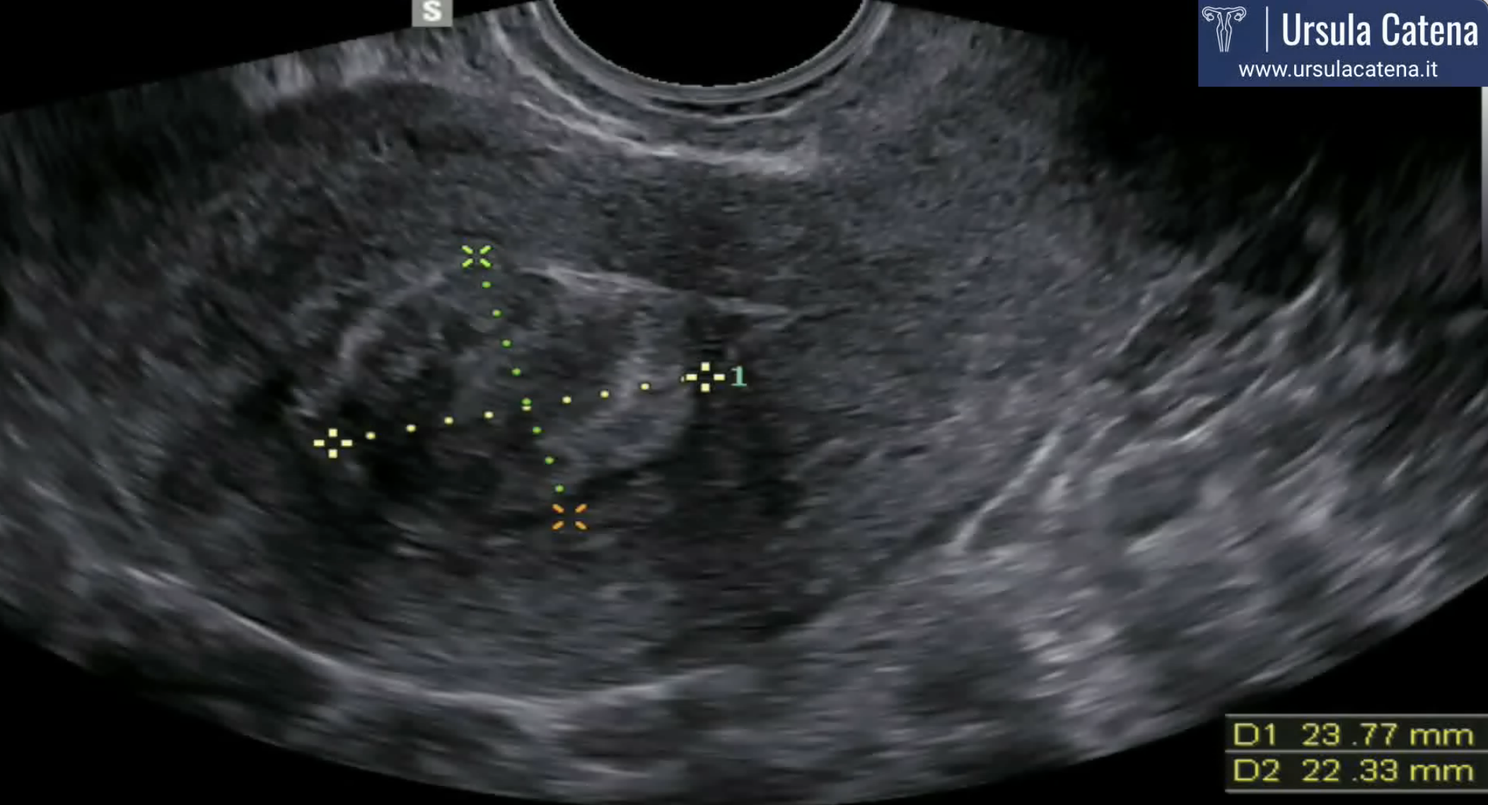 ecografia fibromi uterini